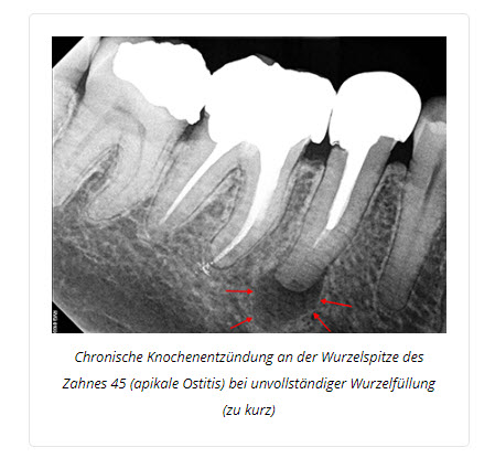 zahn wurzelbehandlung luzern zahnarzt